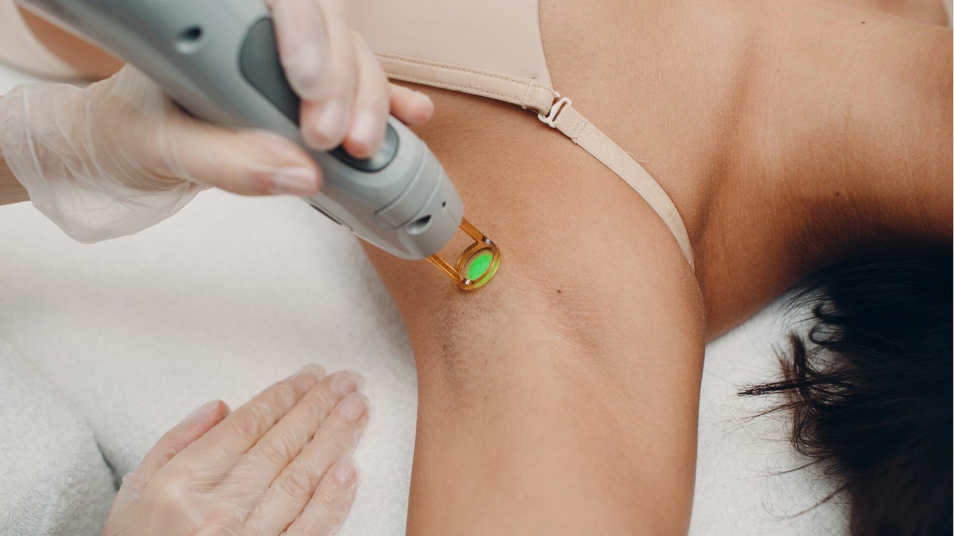 laser hair removal