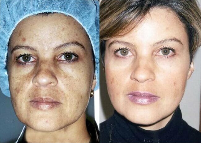 Cosmelan Depigmentation Peel Aldgate