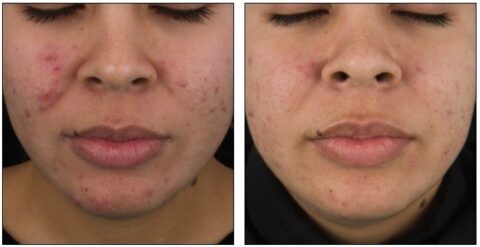 DermaClear Acne Peel Before & After