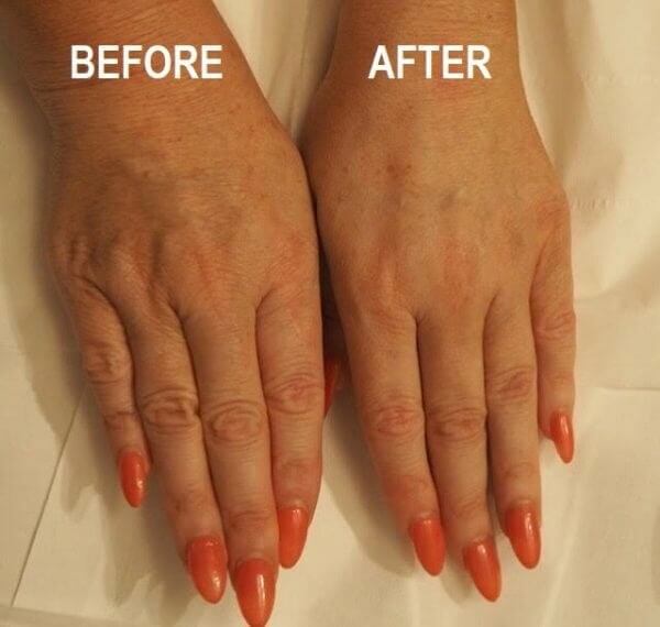 Profhilo before and after