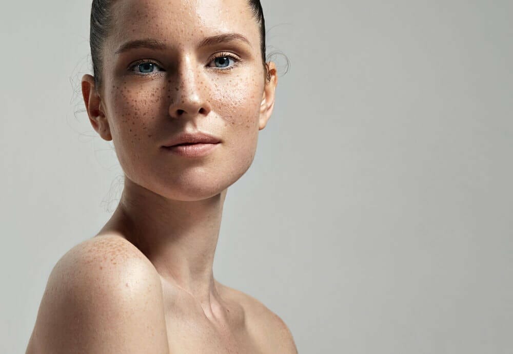 Freckles Pigmentation