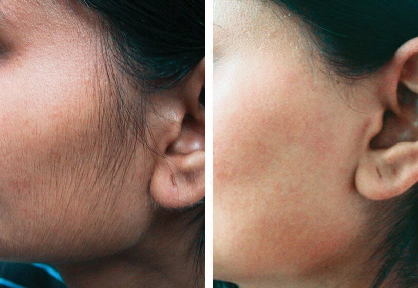 Laser hair removal woman face before after