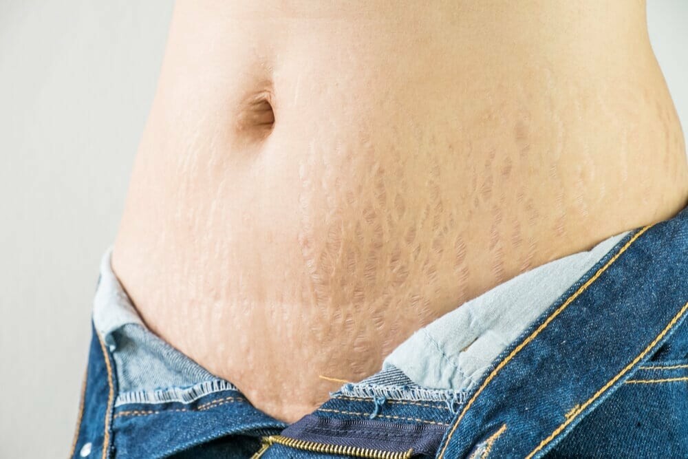 Stretchmarks