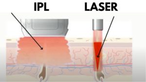 laser hair removal