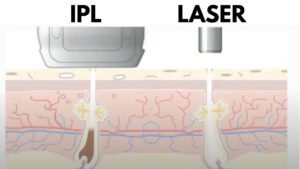 laser hair removal