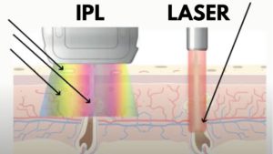 laser hair removal