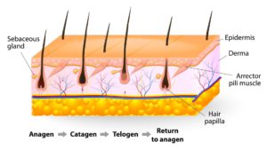 laser hair removal