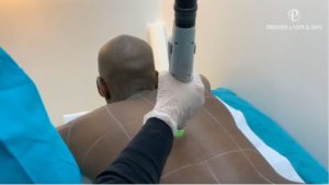 laser hair removal for men
