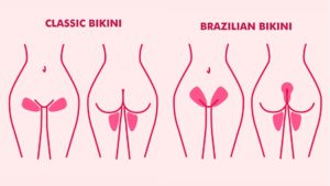 bikini laser