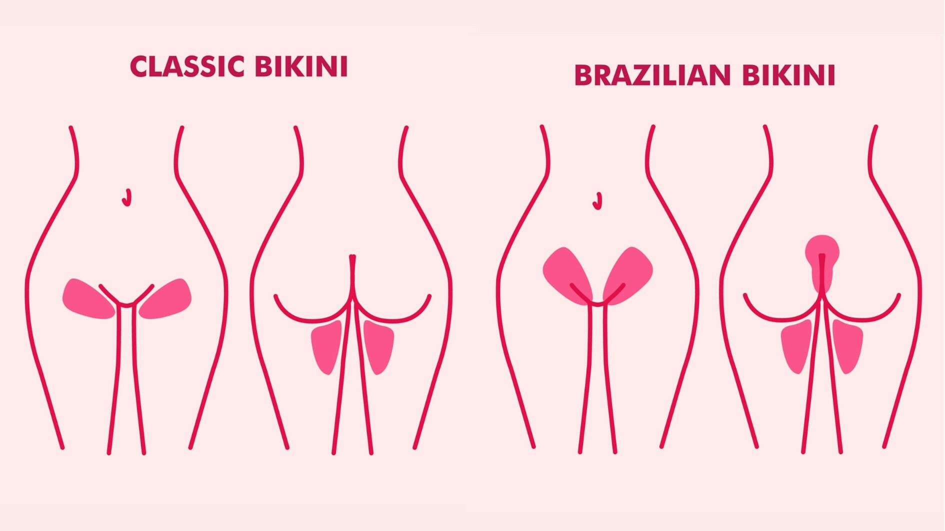 bikini laser