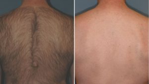 laser hair removal for men