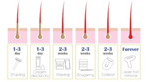 why laser hair remvoal