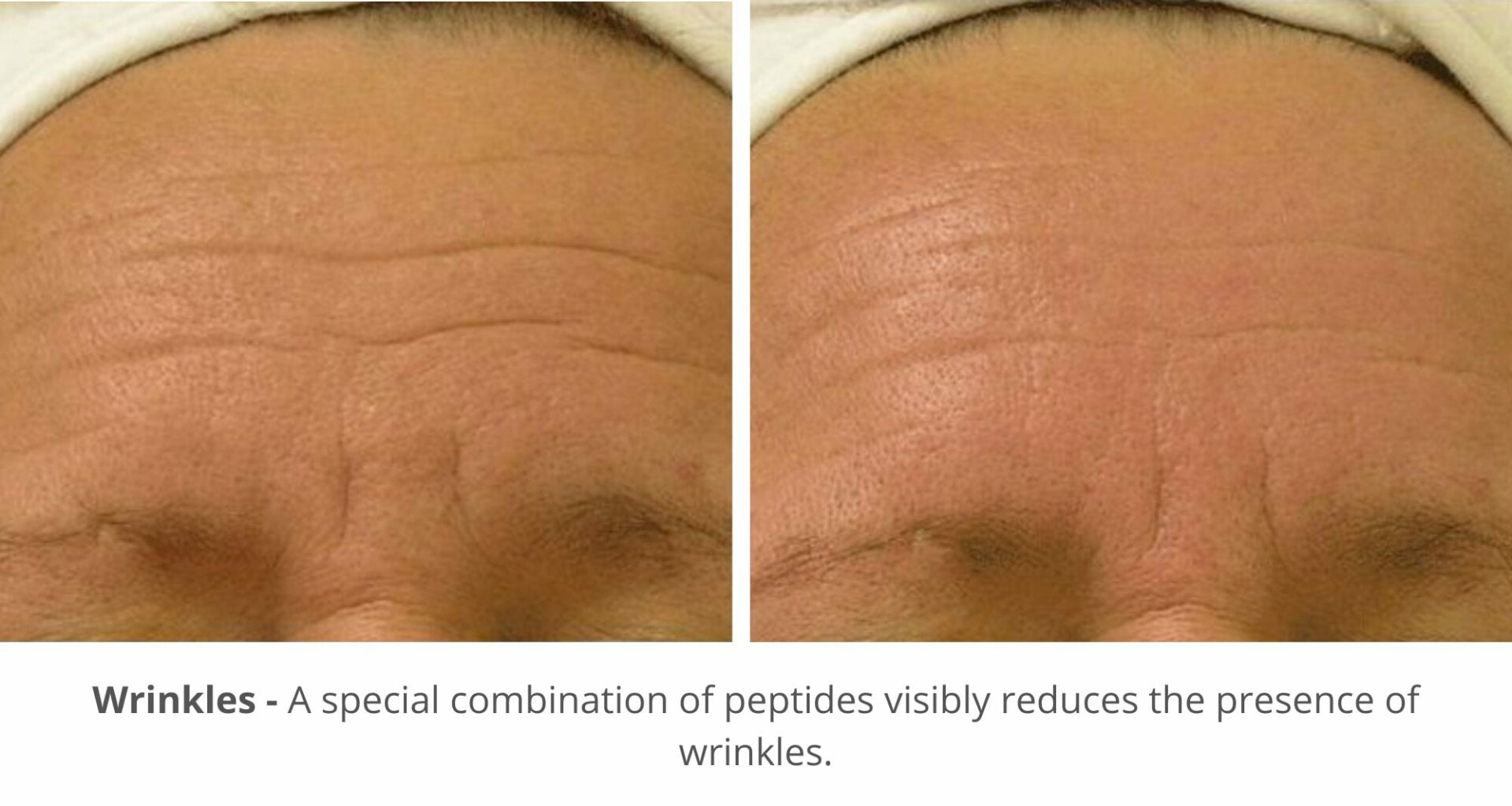 hydrafacial for before and after photo for wrinkles