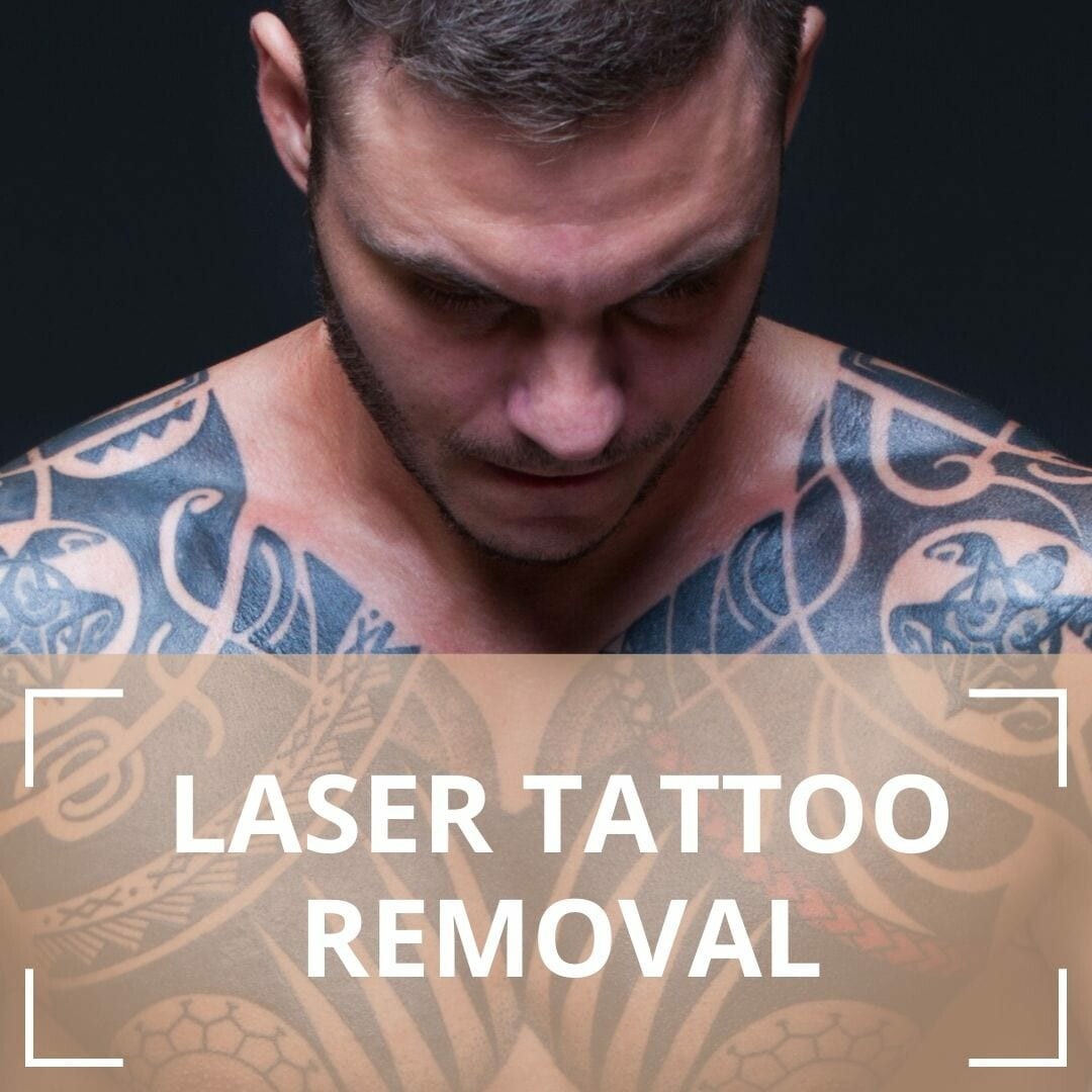 tattoo removal