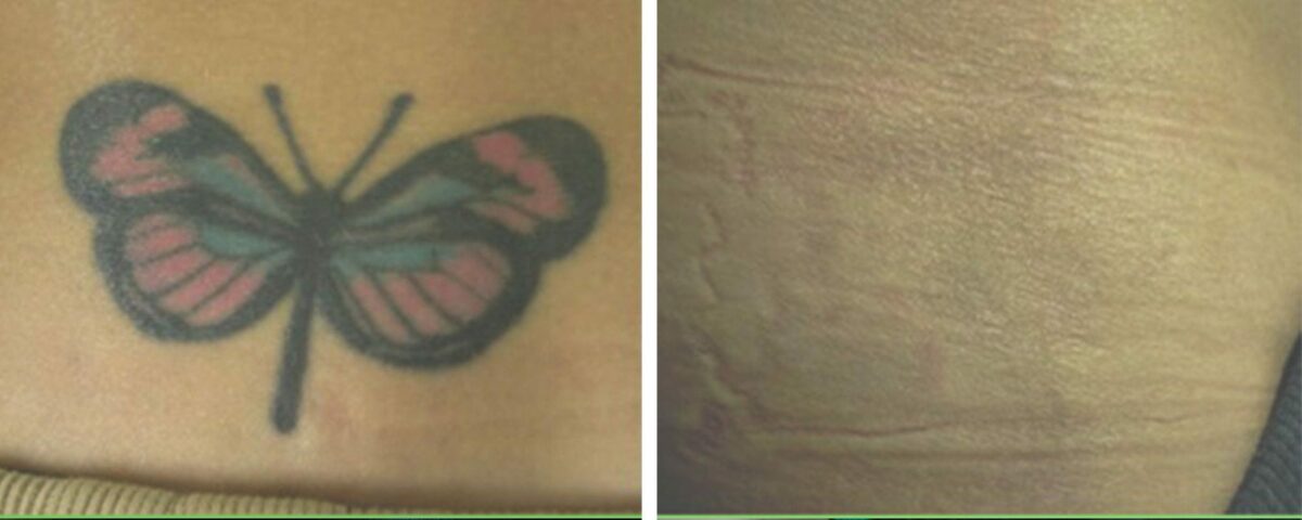 laser tattoo removal