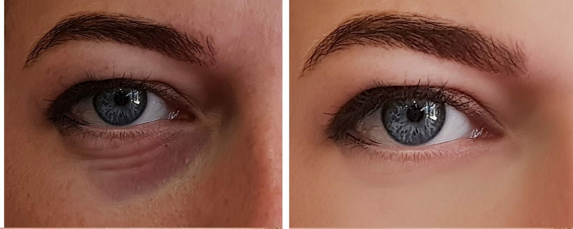 eye bag before and after