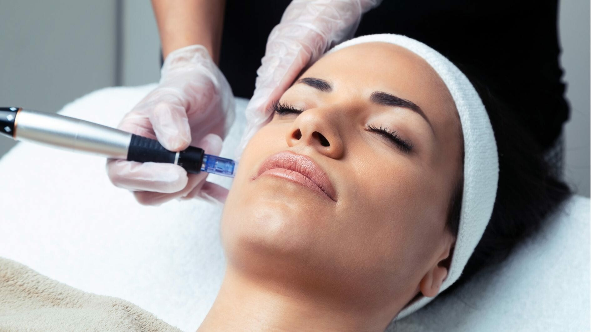microneedling with a dermapen