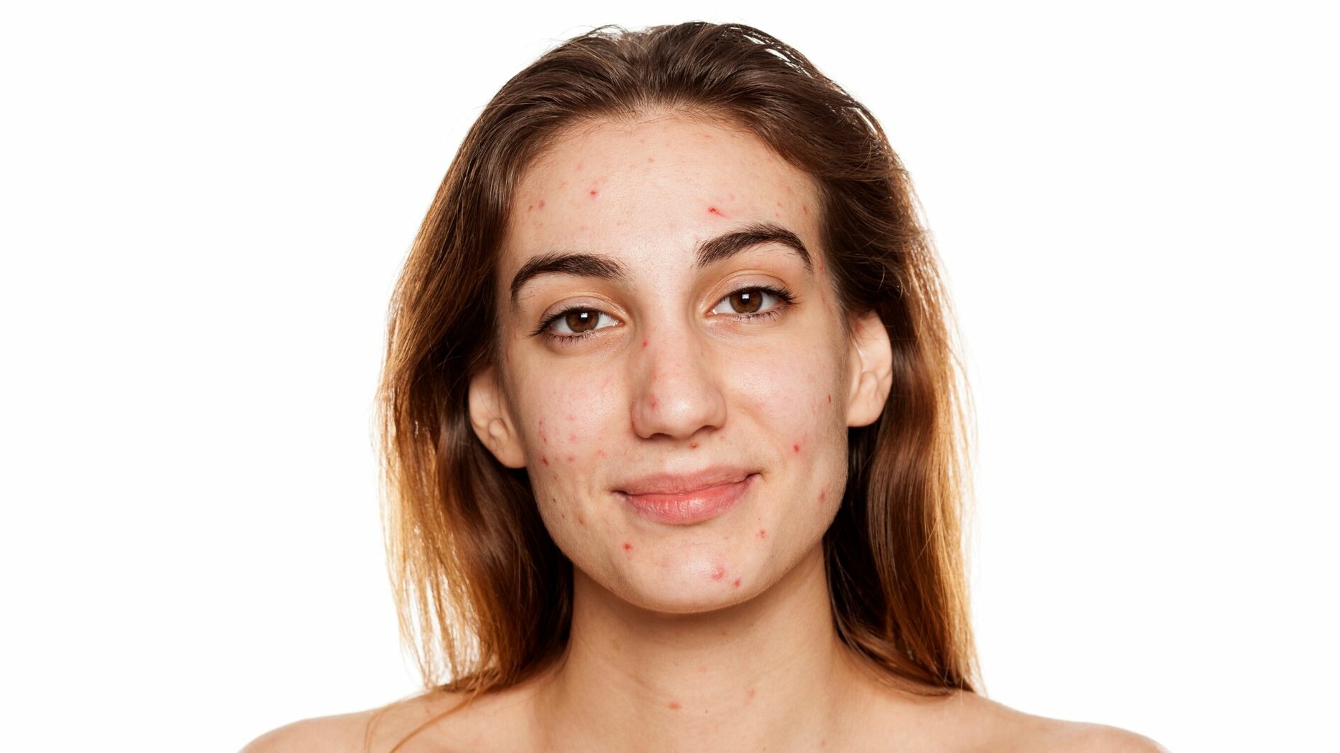 acne model