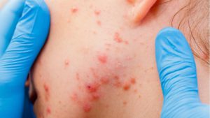 hydrafacial acne
