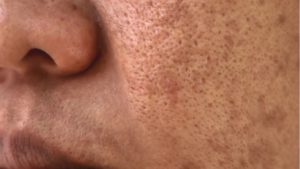 hydrafacial melasma