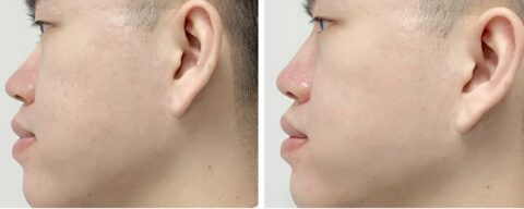 microneedling before and after
