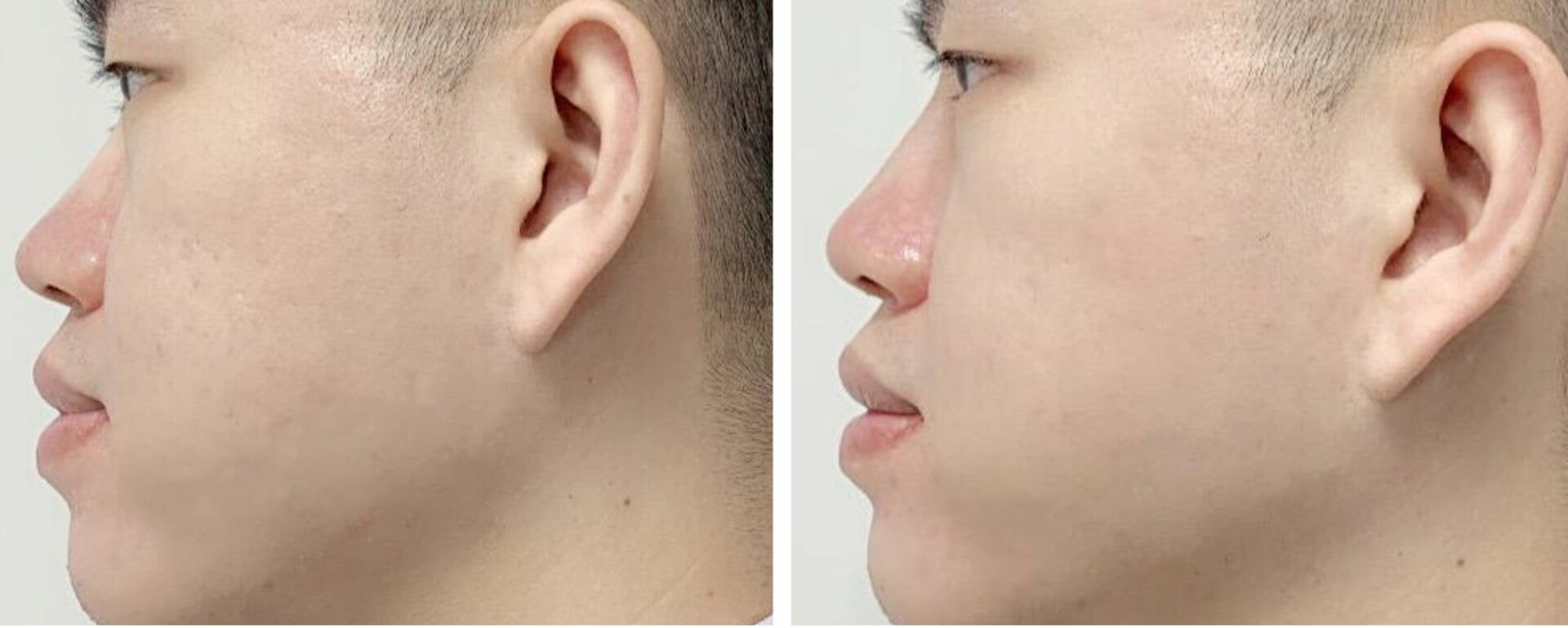 microneedling before and after