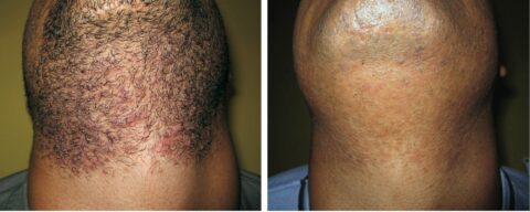 laser for men on chin pic