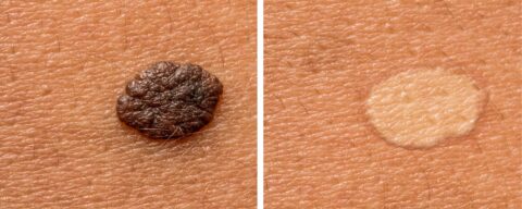 skin tag removal