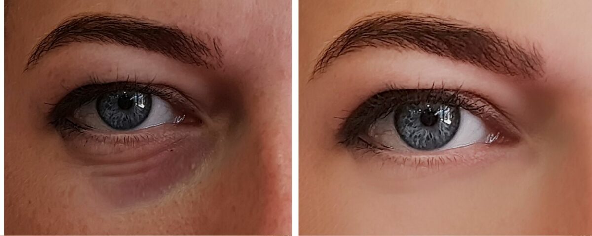 Fighting Those Dark Circles Under Your Eyes!
