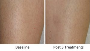 Leg Hair Removal Baseline and Post Three Treatments before and after leg laser hair removal, post 3 treatments after