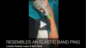 Preparing for laser hair removal and how it feels