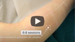 laser hair removal