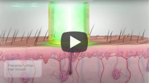 laser hair removal