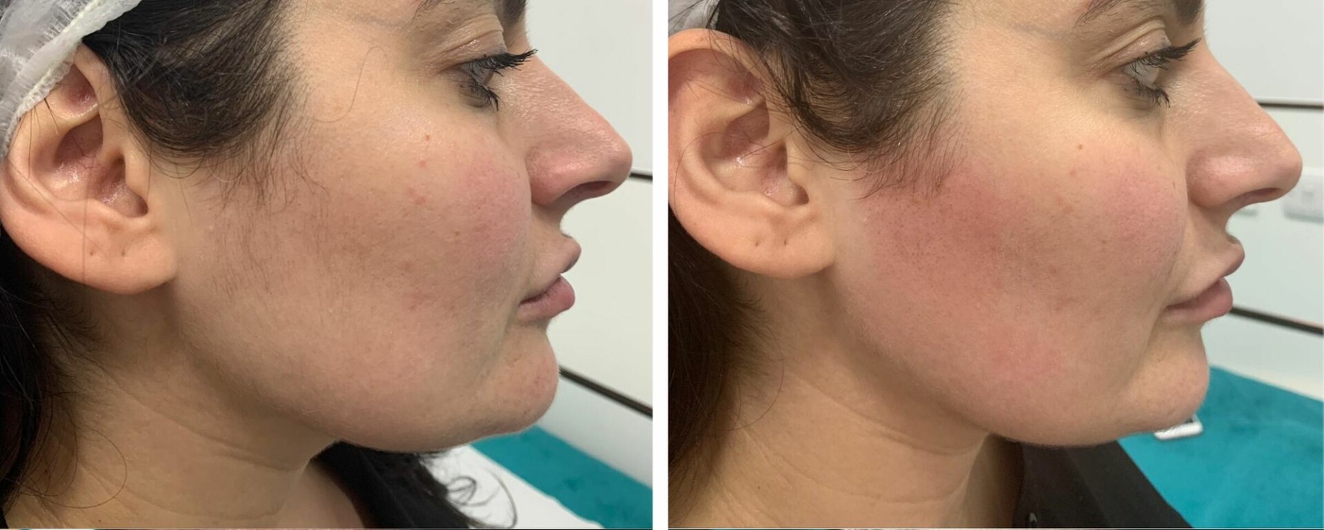 facial laser hair removal before and after photo