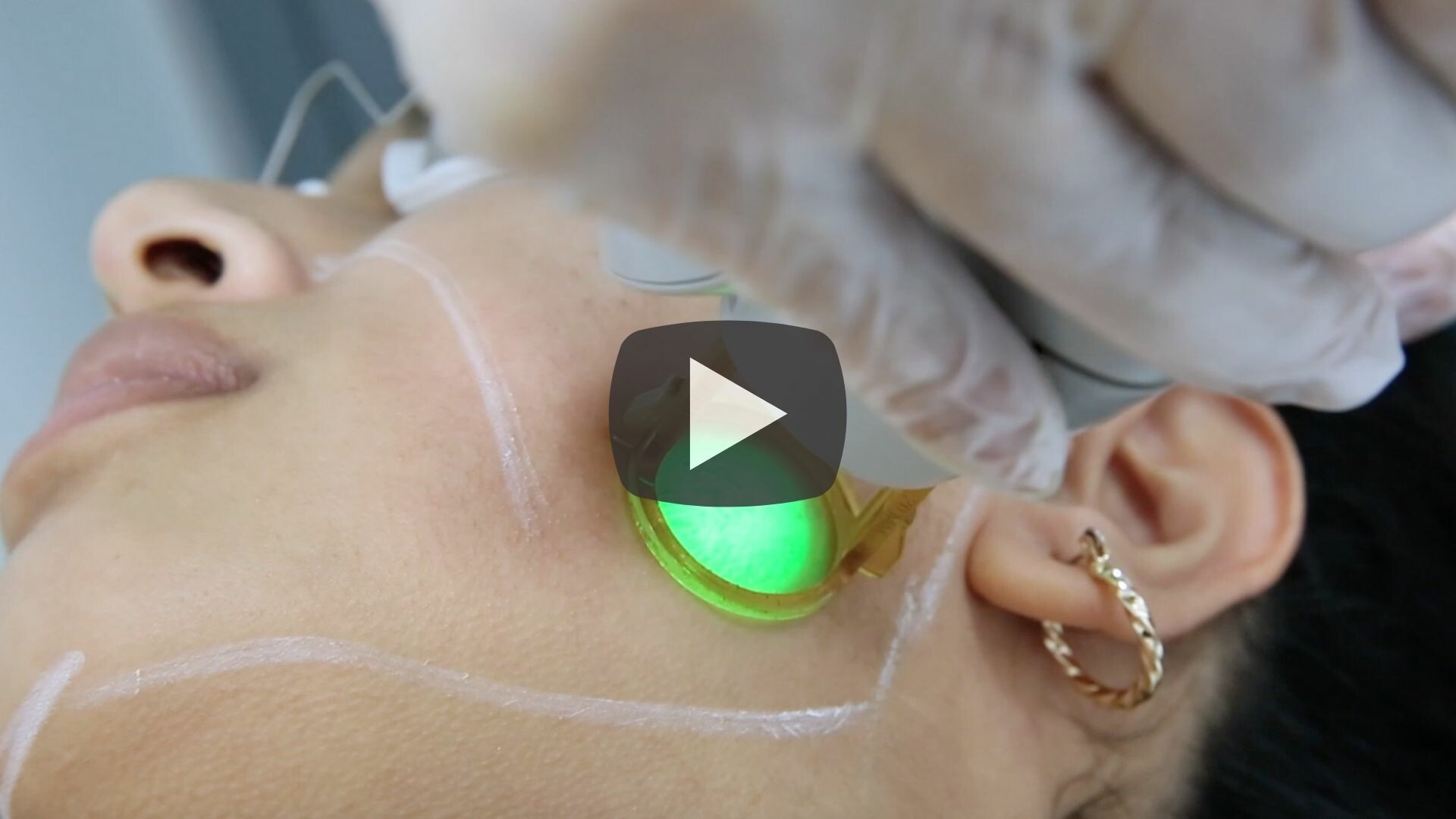 laser hair removal for face premier laser youtube video