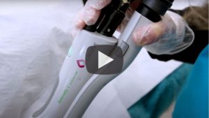 laser hair removal