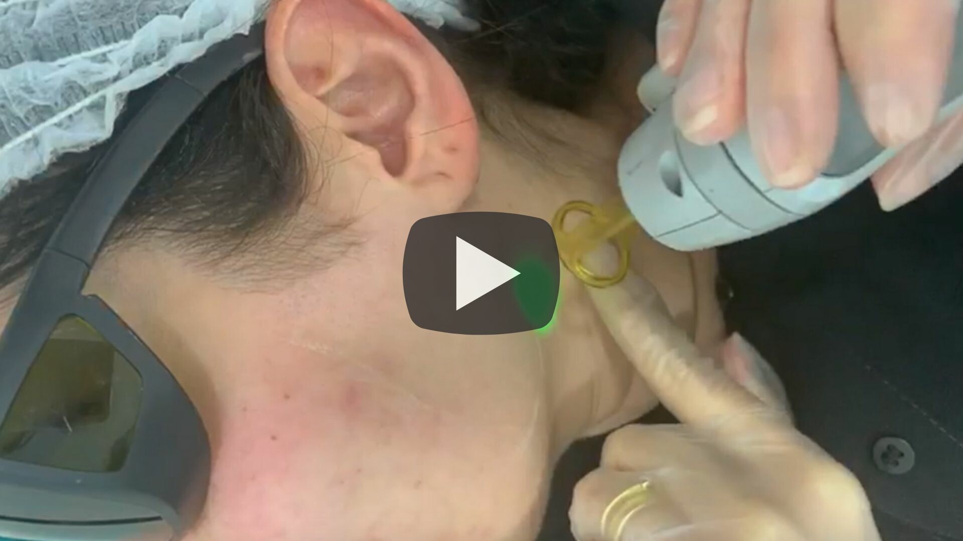 laser hair removal sideburns youtube video premier laser
