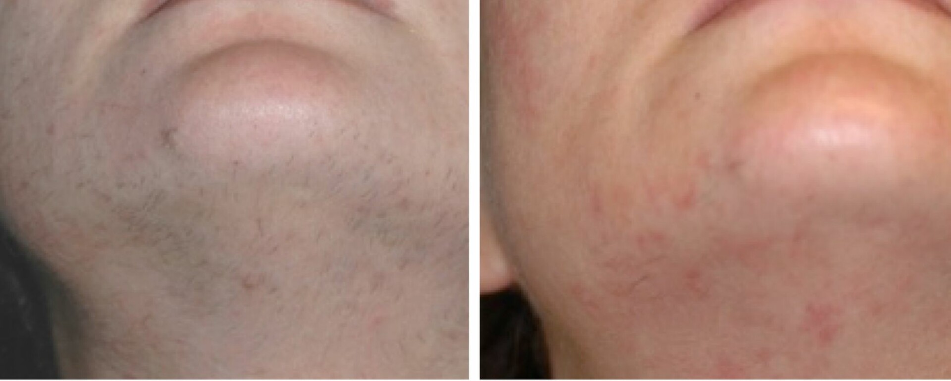 chin laser hair removal before and after photo