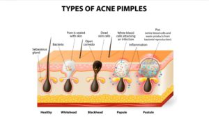 hydrafacial or chemical peel