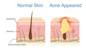 hydrafacial or chemical peel