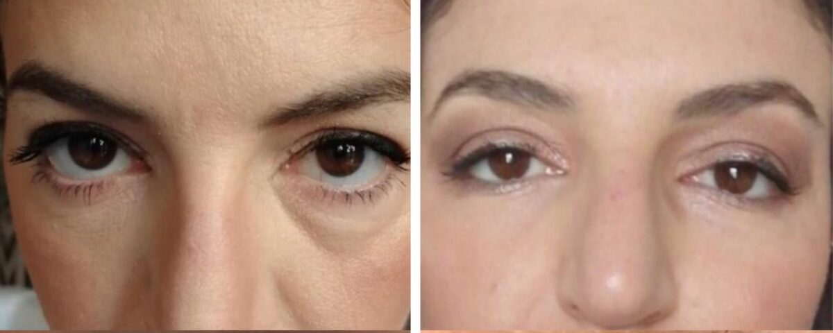 The Under Eye Area: Why the Most Sensitive Part Of Your Face Needs Special Attention