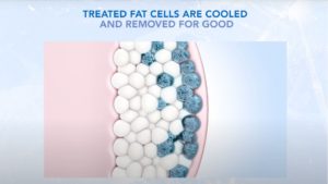 lovehandles coolsculpting 