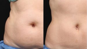 coolsculpting London
