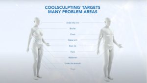 coolsculpting London