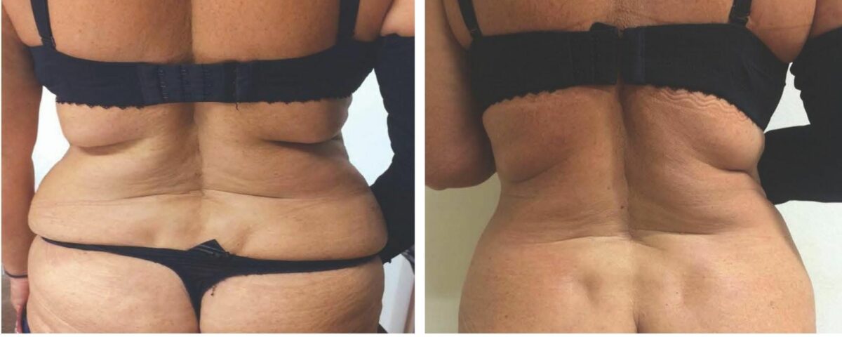 The science behind Cryotherapy Fat Reduction