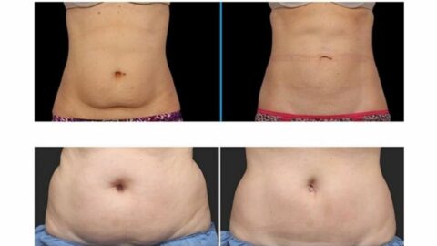 Abdominal fat reduction with coolsculpting
