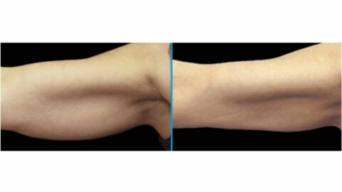 arm fat reduction before and after