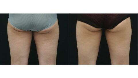 inner thigh fat reduction