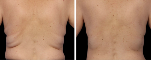 backfat coolsculpting