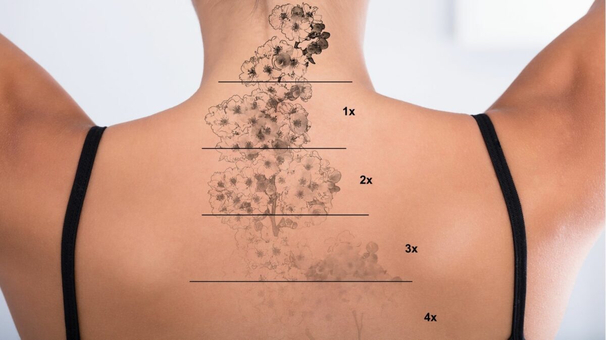 Tattoo removal with Lumenis Stellar M22 laser